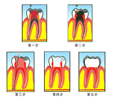 根管治療,根管治療步驟,根管治療方法