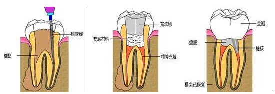 深圳牙髓炎的根管治療費用