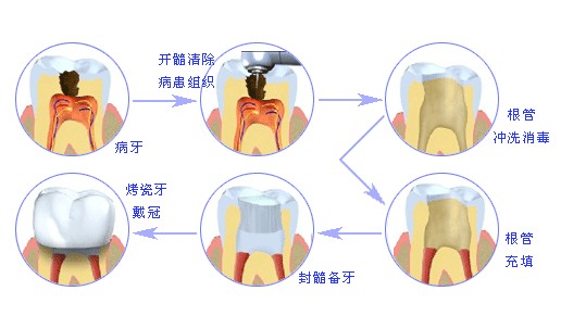 根管治療的步驟 