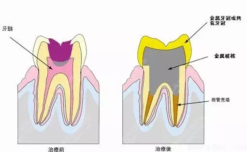 牙齒的根管治療啥意思?