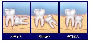 智齒一定要拔嗎