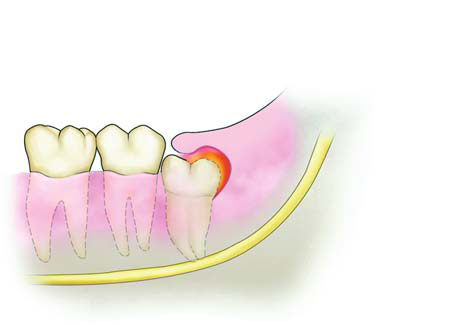 拔智齒要多少錢