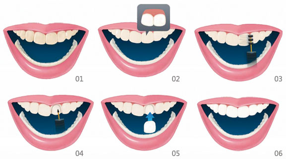 影響瓷貼麵價(jia) 格的主要因素