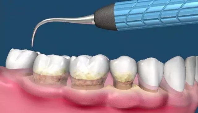 為(wei) 什麽(me) 要定期洗牙?