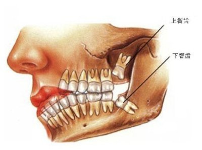 智齒有必要拔除嗎