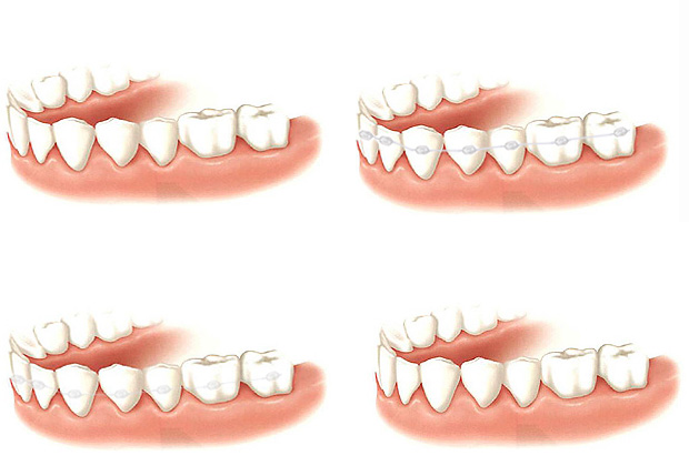 牙列稀疏的原因