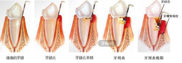 慢性齦緣炎的臨(lin) 床表現和病理