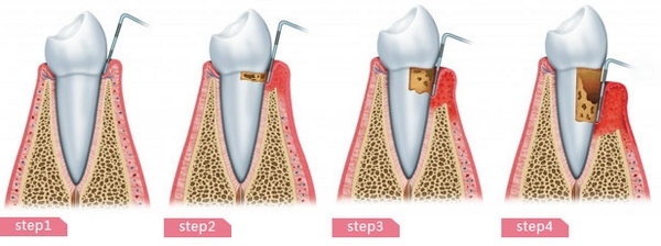牙齦炎的主要治療方法是什麽(me) 