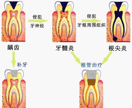 急性牙髓炎**吃哪些東(dong) 西好