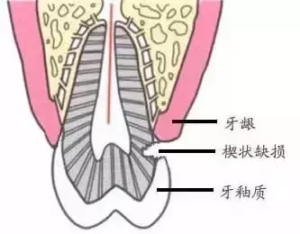 什麽(me) 是楔狀缺損