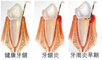 牙齦出血是不是牙周炎