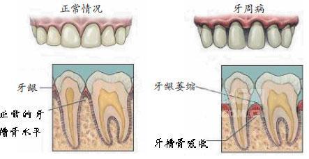牙齒鬆動,到底要不要拔?