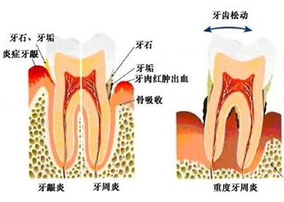 鬆動的牙齒是不是一定要拔掉？牙齒鬆動的影響