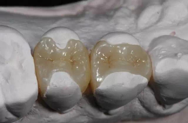 嵌體(ti) 補牙的優(you) 點