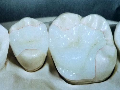 牙體(ti) 缺損修複方法嵌體(ti) 或者冠修複