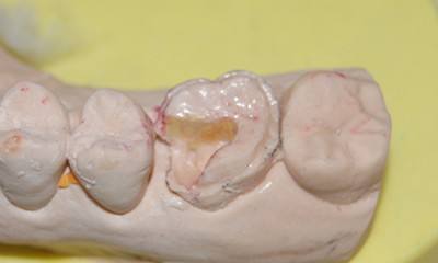 深圳牙齒嵌體(ti) 的種類有哪些呢？