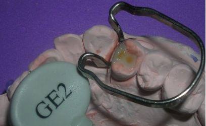 瓷嵌體(ti) 補牙價(jia) 格受哪些因素影響