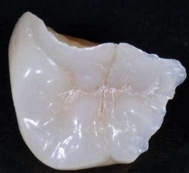深圳瓷嵌體(ti) 具有哪些好處?
