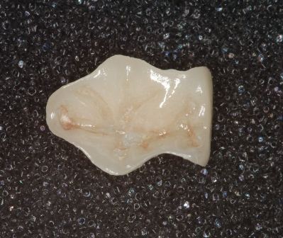 嵌體(ti) 修複要多少錢