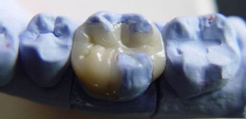 樹脂嵌體(ti) ，補牙的另一種方法