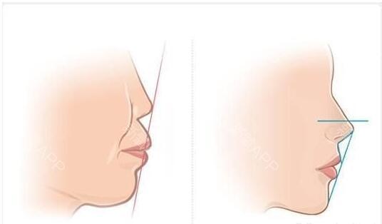 3、齙牙——唇凸影響麵部曲線