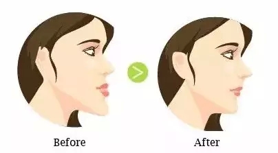 牙齒反頜、牙齒對臉型的影響到底有多大？