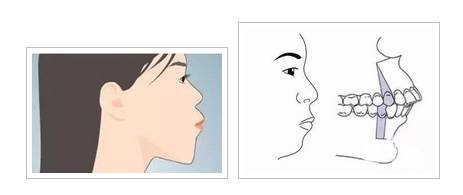牙齒反頜、牙齒對臉型的影響到底有多大？