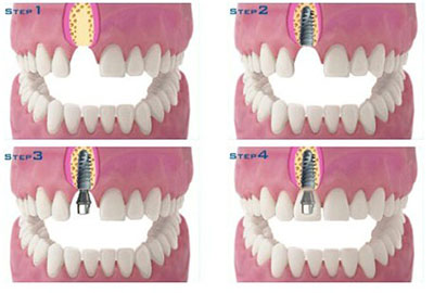 深圳門牙掉了一小塊怎麽(me) 辦？
