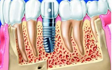 拔牙後多久種牙好,視口腔情況而定