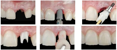 影響即刻種植牙價(jia) 格的因素