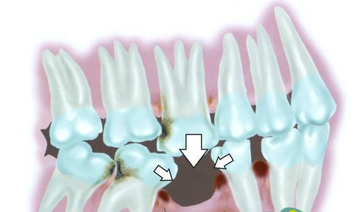 牙齒缺失危害多多 種植牙是您的較佳選擇