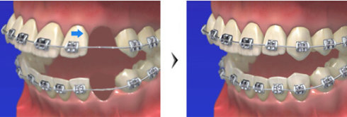 矯正還在猶豫時,千萬(wan) 不要先拔牙!