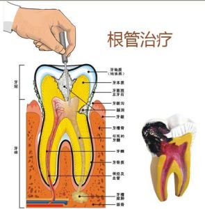 根管治療的時候針斷在裏麵了，該怎麽(me) 辦!
