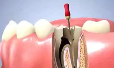 想做根管治療，你需要知道這些關(guan) 於(yu) 根管治療的問題？