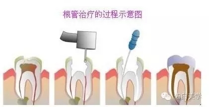 根管治療後如何保護牙齒延長壽命