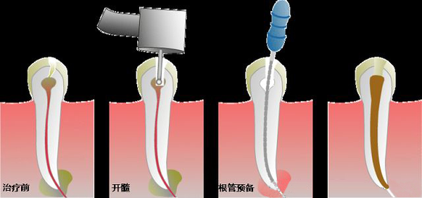 做完根管治療後，是做嵌體(ti) 好還是牙套好？