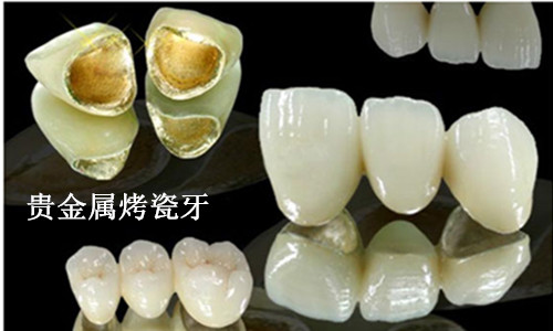 黃金烤瓷牙