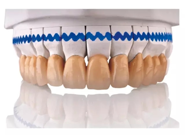 做烤瓷牙為(wei) 什麽(me) 要留金屬邊?