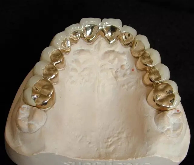 做烤瓷牙為(wei) 什麽(me) 要留金屬邊?