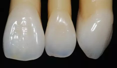 做烤瓷牙為(wei) 什麽(me) 要留金屬邊?