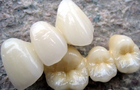 全瓷牙美白黃牙好不好呢?