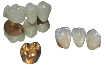 黃金烤瓷牙的價(jia) 格多少錢