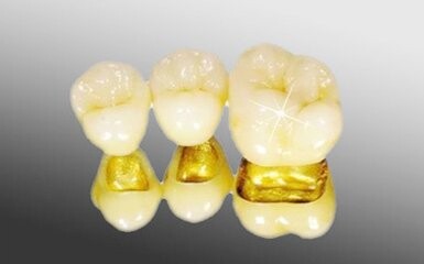 黃金烤瓷牙為(wei) 什麽(me) 那麽(me) 貴?