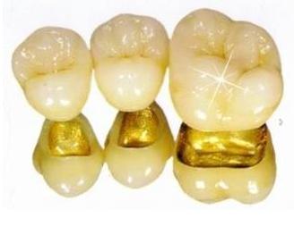 什麽(me) 是黃金烤瓷牙,是純金的嗎?