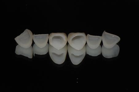 二氧化鋯全瓷牙是好的嗎