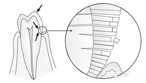 淺談牙頸部缺損--關(guan) 於(yu) 楔狀缺損與(yu) 酸蝕症