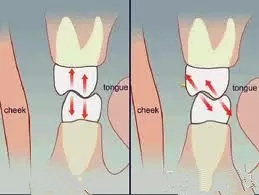 淺談牙頸部缺損--關(guan) 於(yu) 楔狀缺損與(yu) 酸蝕症