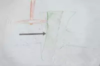 淺談牙頸部缺損--關(guan) 於(yu) 楔狀缺損與(yu) 酸蝕症