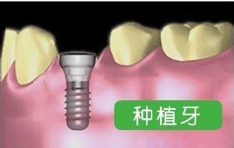 告訴您種植牙不疼的秘密