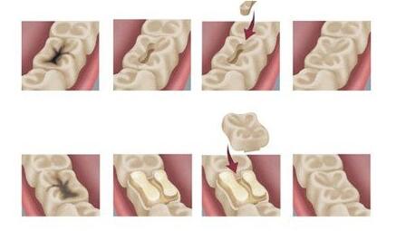 深圳補牙哪種材料好